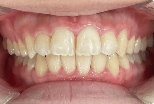 スマイルモア矯正でガタガタの歯並びを矯正した画像