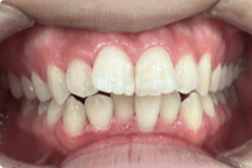 スマイルモア矯正でガタガタの歯並びを矯正した画像