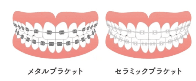 ワイヤー矯正は目立ちやすい