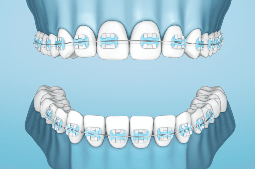 3次元スキャンを用いた異なるブラケットプレスクリプションが矯正治療結果に及ぼす影響