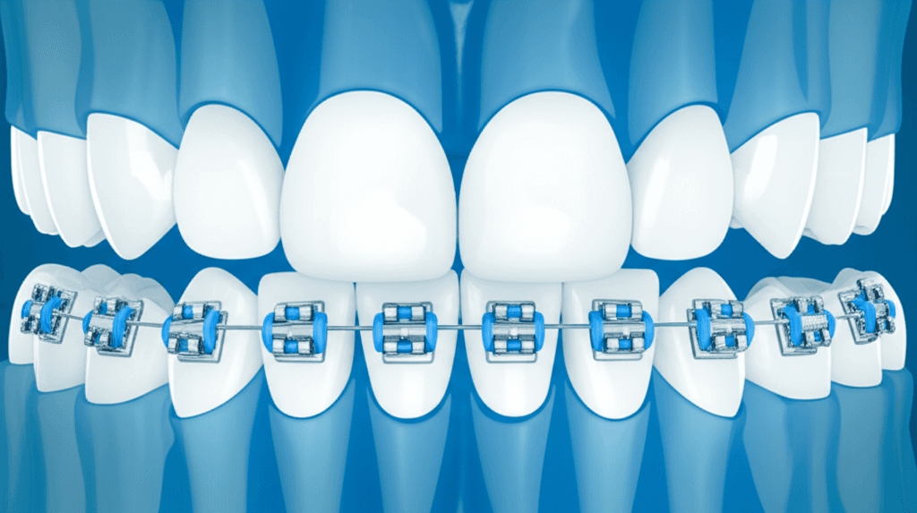矯正治療および異なるフッ化物使用法がう蝕誘発細菌数とう蝕リスクに及ぼす影響:ランダム化比較試験