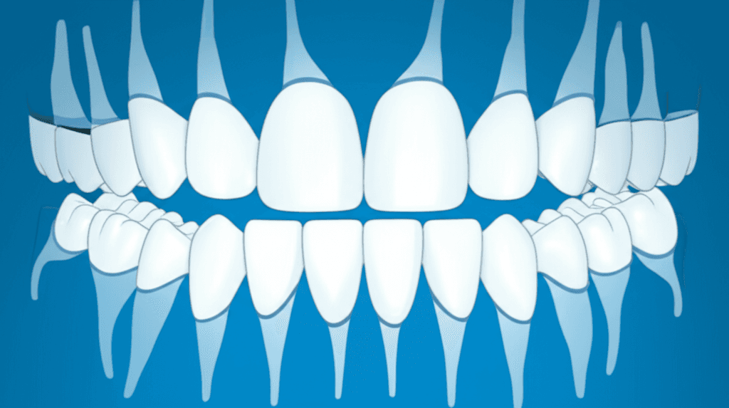 固定式矯正装置による治療後の天然歯の色調変化:前向き臨床試験
