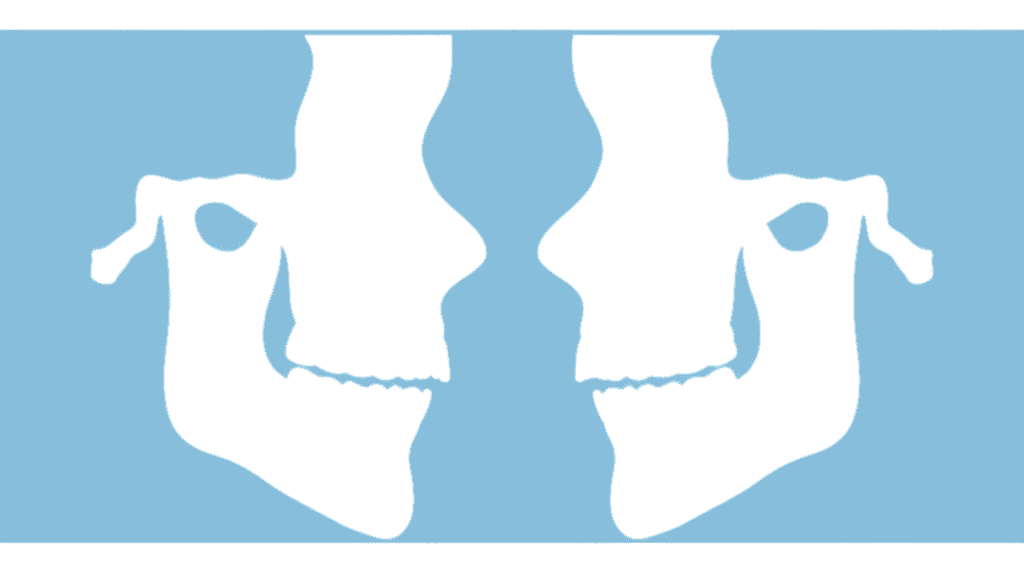 アライナー矯正と固定式装置が発音に及ぼす影響の比較