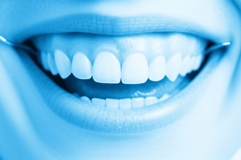 固定式矯正装置装着患者における初期う蝕予防のためのフッ化物洗口剤:システマティックレビューおよびメタ解析