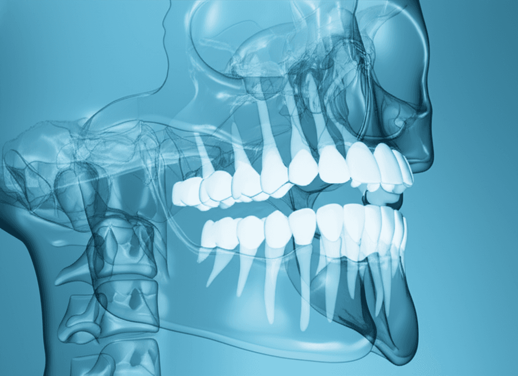 固定式装置による矯正治療後のう蝕転帰:裏側矯正装置は違いをもたらすか?