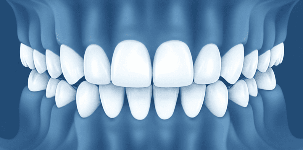 ニッケルチタンワイヤーとニオブ・チタン・タンタル・ジルコニウムワイヤーを用いた思春期患者の初期配列における叢生および歯列弓幅径の変化の比較:二重盲検ランダム化比較試験