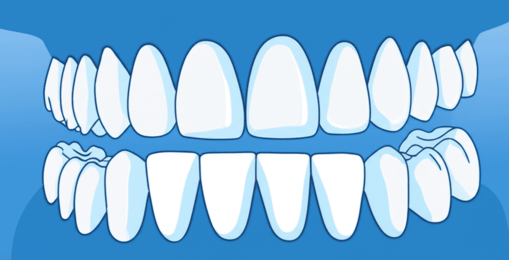 前歯部反対咬合の改善の安定性:2年間の追跡調査を伴うランダム化比較試験