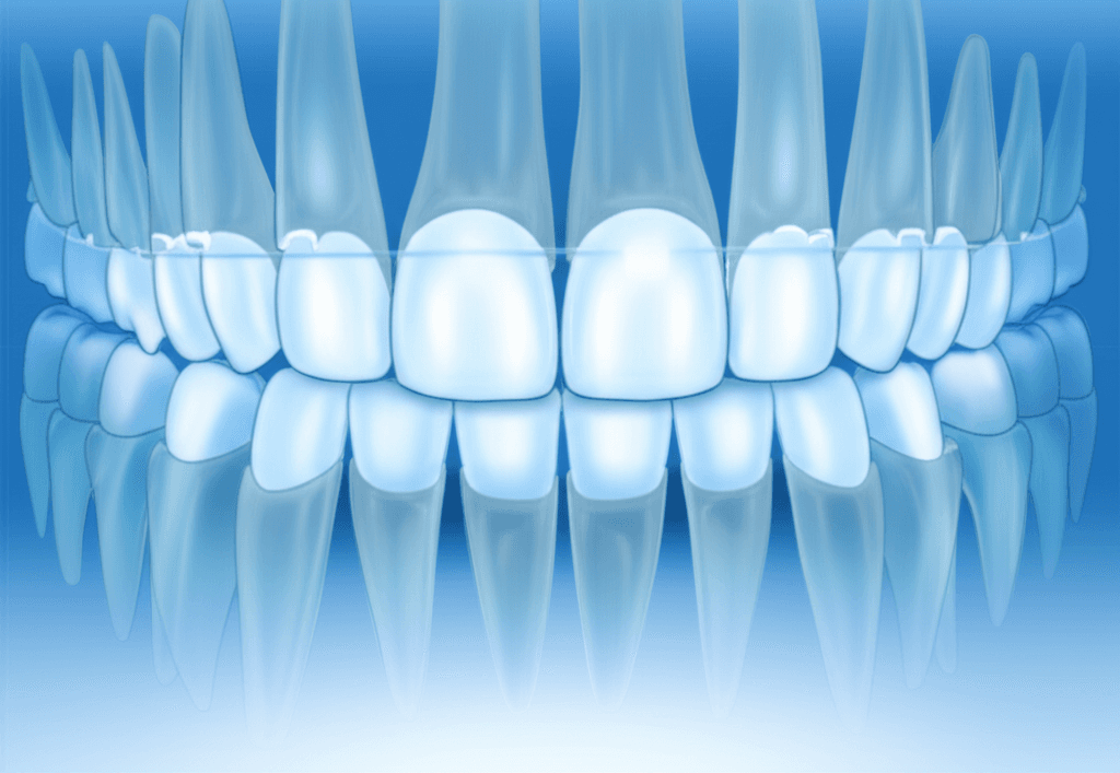 固定式矯正装置装着中のう蝕抑制に対するCO2レーザーの併用効果:ランダム化分割口内対照臨床試験のプロトコル