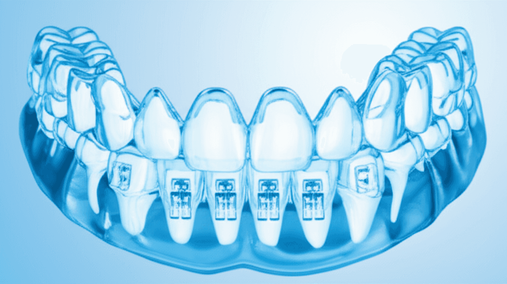 下顎結合部ミニプレート固定システムを用いた前後的骨格性不正咬合の改善:成功率と合併症について